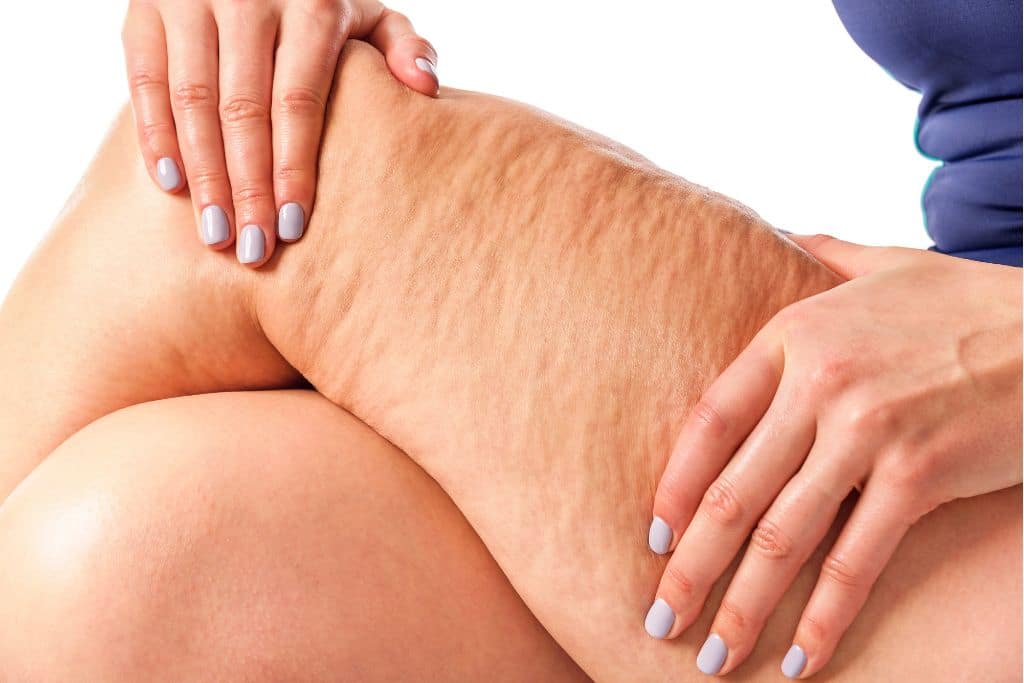 Can Weight Loss Eliminate Cellulite