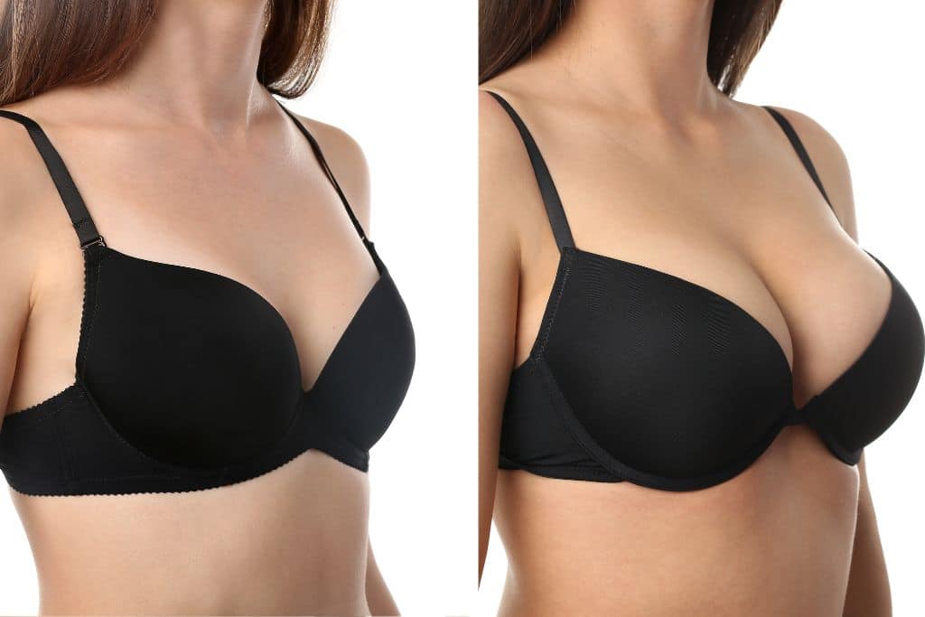 Is Weight Loss Easier After Breast Reduction