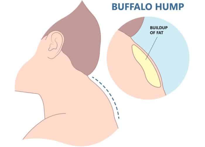Understanding Buffalo Hump