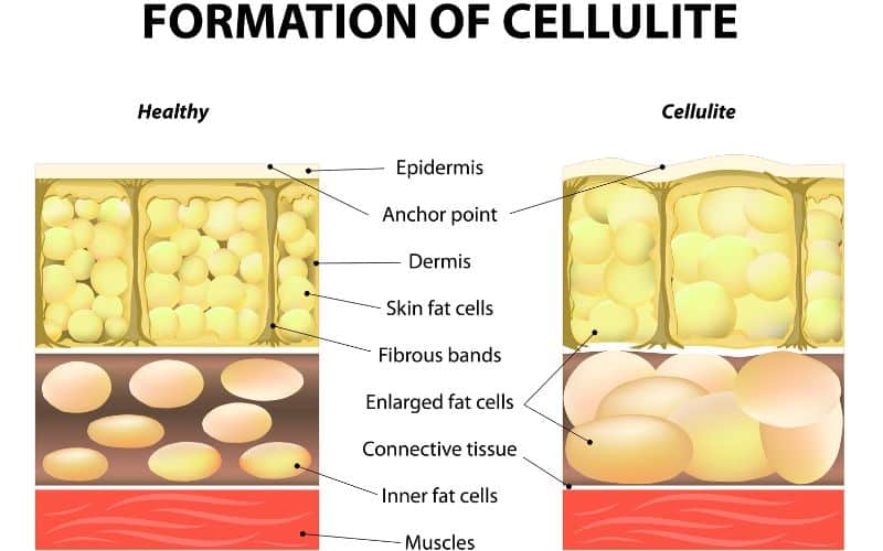 Understanding Cellulite