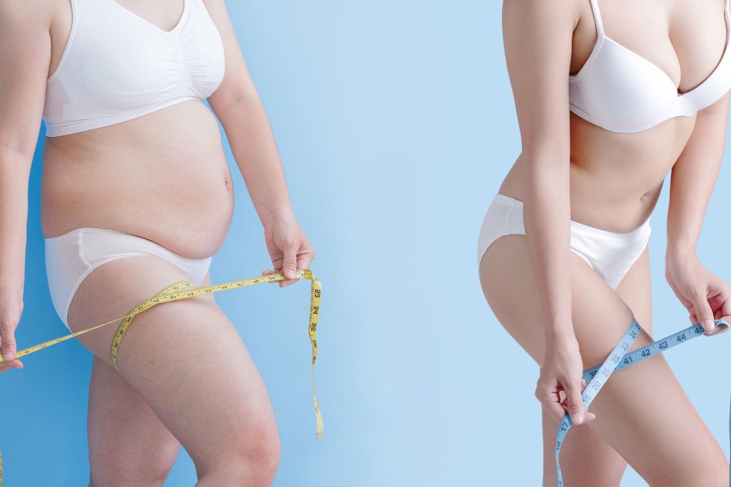 Weight Loss Easier After Liposuction