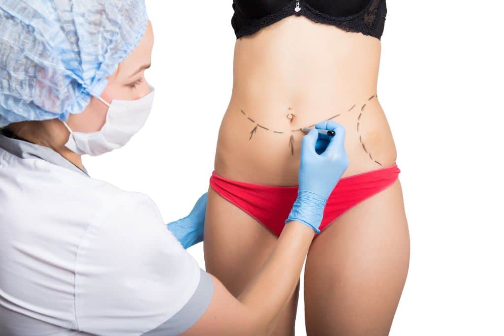 Female doctor makes dotted line on female body for cosmetic surgery