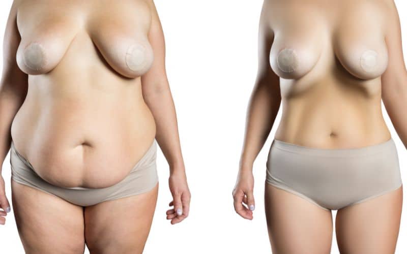 Psychological Aspects of Weight Loss After Breast Reduction
