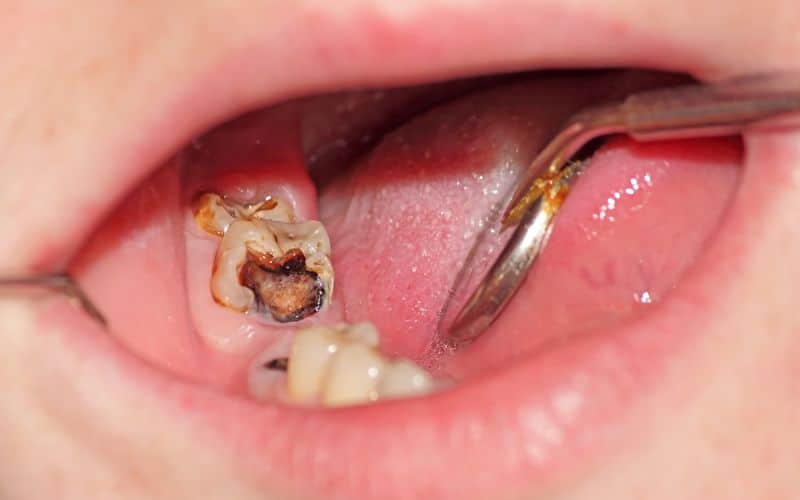 tooth decay lower molar