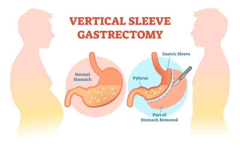 Understanding Gastric Sleeve Surgery