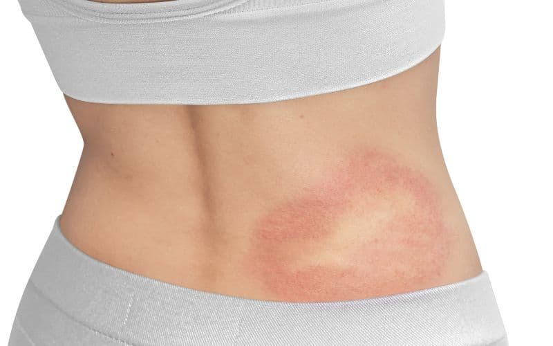 Red rash allergic skin on the waist of the back of a woman